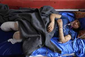 «Πού είναι το πόδι μου;»: Συγκλονίζουν τα ακρωτηριασμένα παιδιά στην εμπόλεμη Γάζα (video με σκληρές εικόνες)