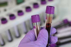 Αλτσχάιμερ: Νέα εξέταση αίματος θα μπορούσε να φέρει επανάσταση στη διάγνωση της νόσου